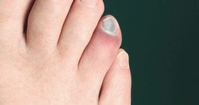 Fracture du petit orteil : causes, symptômes et traitements