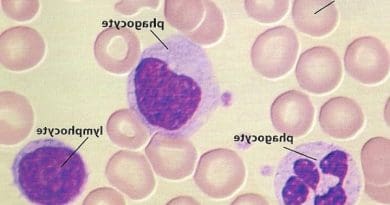 Leucocytes élevés : quelles sont les causes et comment y remédier ?
