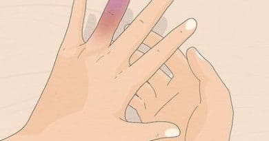 Titre : Comment soigner un doigt cassé ?