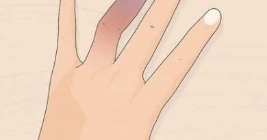 Titre: Comment soigner un doigt cassé rapidement et efficacement ?