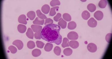 Comprendre les monocytes élevés : causes et traitements